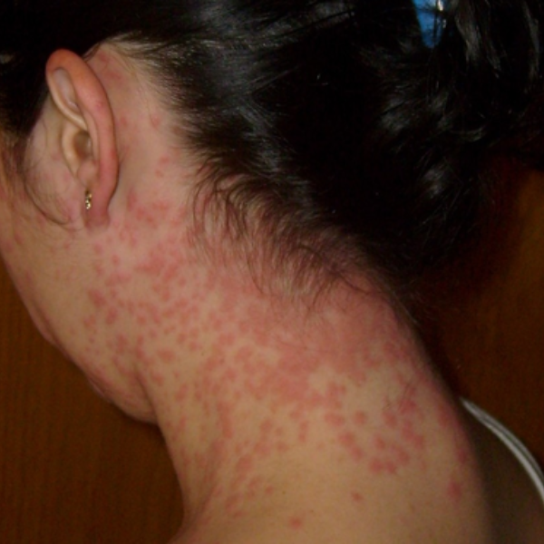 home remedies for skin rashes