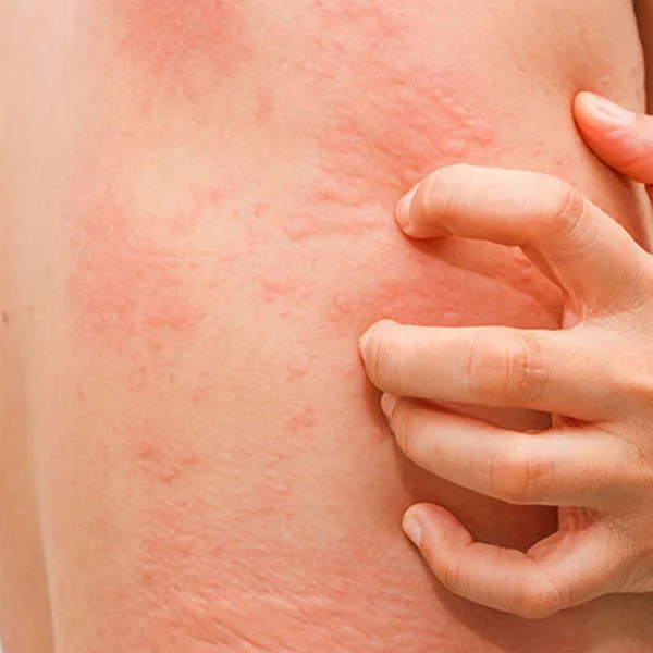 Home Remedies for Skin Rashes